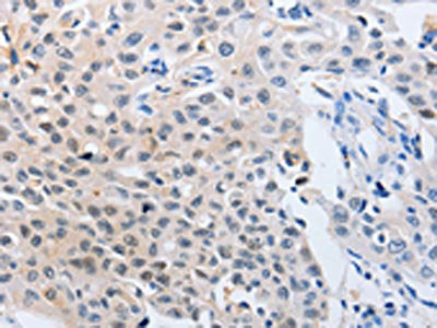 The image on the left is immunohistochemistry of paraffin-embedded Human lung cancer tissue using YWHAQ Antibody(YWHAQ Antibody) at dilution 1/50, on the right is treated with synthetic peptide. (Original magnification: ×200)Rabbit anti-Human YWHAQ Polyclonal Antibody