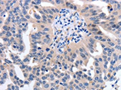 The image on the left is immunohistochemistry of paraffin-embedded Human ovarian cancer tissue using the antibody Antibody) at dilution 1/50, on the right is treated with synthetic peptide. (Original magnification: ×200)Rabbit anti-Human YWHAQ Polyclonal Antibody