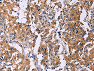 The image on the left is immunohistochemistry of paraffin-embedded Human thyroid cancer tissue using CMTM6 Antibody(CMTM6 Antibody) at dilution 1/40, on the right is treated with synthetic peptide. (Original magnification: ×200)Rabbit anti-Human CMTM6 Polyclonal Antibody