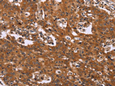 The image on the left is immunohistochemistry of paraffin-embedded Human gastric cancer tissue using the antibody Antibody) at dilution 1/40, on the right is treated with synthetic peptide. (Original magnification: ×200)Rabbit anti-Human CMTM6 Polyclonal Antibody