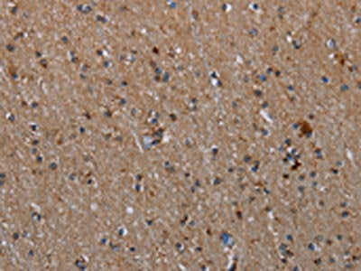 The image on the left is immunohistochemistry of paraffin-embedded Human brain  tissue using MMP23A Antibody(MMP23B Antibody) at dilution 1/20, on the right is treated with synthetic peptide. (Original magnification: ×200)Rabbit anti-Human MMP23A Polyclonal Antibody