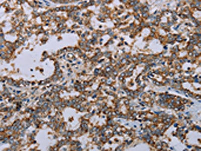 The image on the left is immunohistochemistry of paraffin-embedded Human liver cancer tissue using the antibody Antibody) at dilution 1/20, on the right is treated with synthetic peptide. (Original magnification: ×200)