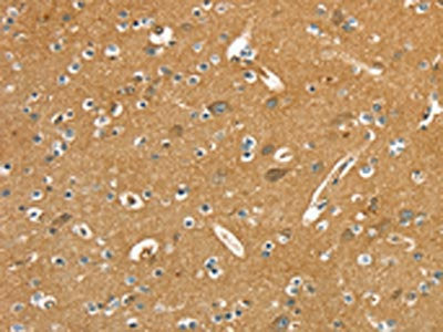 The image on the left is immunohistochemistry of paraffin-embedded Human brain  tissue using PYGL Antibody(PYGL Antibody) at dilution 1/20, on the right is treated with fusion protein. (Original magnification: ×200)Rabbit anti-Human PYGL Polyclonal Antibody