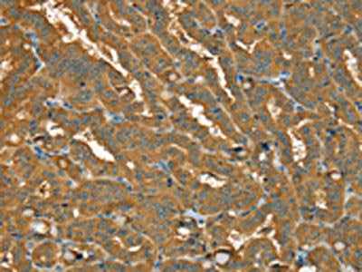 The image on the left is immunohistochemistry of paraffin-embedded Human thyroid cancer tissue using the antibody Antibody) at dilution 1/20, on the right is treated with fusion protein. (Original magnification: ×200)Rabbit anti-Human PYGL Polyclonal Antibody