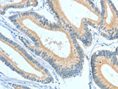 The image on the left is immunohistochemistry of paraffin-embedded Human colon cancer tissue using ASGR1 Antibody(ASGR1 Antibody) at dilution 1/50, on the right is treated with fusion protein. (Original magnification: ×200)Rabbit anti-Human ASGR1 Polyclonal Antibody