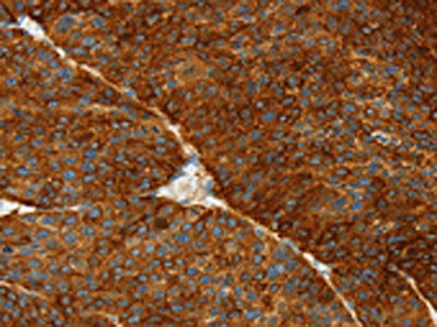 The image on the left is immunohistochemistry of paraffin-embedded Human liver cancer tissue using the antibody Antibody) at dilution 1/50, on the right is treated with fusion protein. (Original magnification: ×200)Rabbit anti-Human ASGR1 Polyclonal Antibody