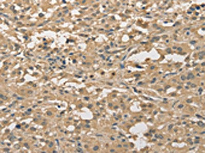 The image on the left is immunohistochemistry of paraffin-embedded Human thyroid cancer tissue using the antibody Antibody) at dilution 1/30, on the right is treated with fusion protein. (Original magnification: ×200)Rabbit anti-Human ALDH8A1 Polyclonal Antibody