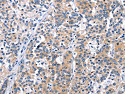 The image on the left is immunohistochemistry of paraffin-embedded Human esophagus cancer tissue using CEP97 Antibody(CEP97 Antibody) at dilution 1/25, on the right is treated with fusion protein. (Original magnification: ×200)Rabbit anti-Human CEP97 Polyclonal Antibody