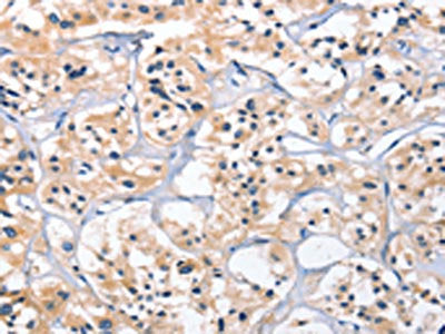 The image on the left is immunohistochemistry of paraffin-embedded Human thyroid cancer tissue using the antibody Antibody) at dilution 1/25, on the right is treated with fusion protein. (Original magnification: ×200)Rabbit anti-Human CEP97 Polyclonal Antibody