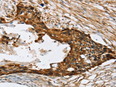 The image on the left is immunohistochemistry of paraffin-embedded Human esophagus cancer tissue using TPD52L2 Antibody(TPD52L2 Antibody) at dilution 1/20, on the right is treated with synthetic peptide. (Original magnification: ×200)Rabbit anti-Human TPD52L2 Polyclonal Antibody