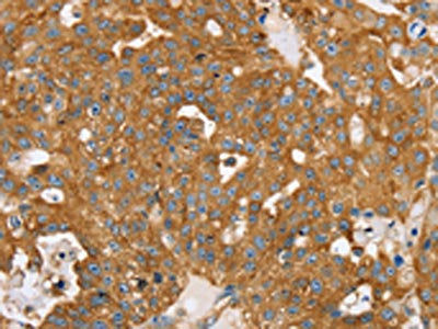 The image on the left is immunohistochemistry of paraffin-embedded Human breast cancer tissue using the antibody Antibody) at dilution 1/20, on the right is treated with synthetic peptide. (Original magnification: ×200)Rabbit anti-Human TPD52L2 Polyclonal Antibody