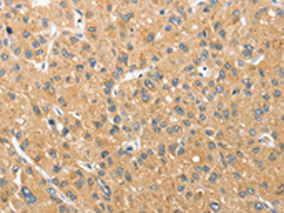 The image on the left is immunohistochemistry of paraffin-embedded Human liver cancer tissue using ANAPC5 Antibody(ANAPC5 Antibody) at dilution 1/30, on the right is treated with fusion protein. (Original magnification: ×200)Rabbit anti-Human ANAPC5 Polyclonal Antibody
