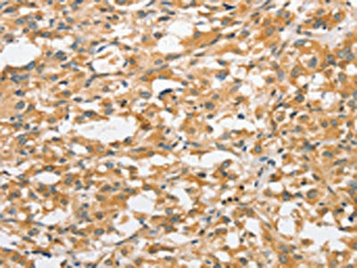 The image on the left is immunohistochemistry of paraffin-embedded Human thyroid cancer tissue using the antibody Antibody) at dilution 1/30, on the right is treated with fusion protein. (Original magnification: ×200)Rabbit anti-Human ANAPC5 Polyclonal Antibody