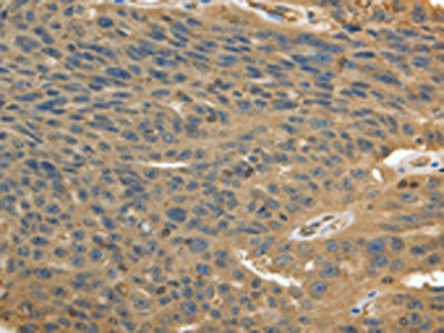 The image on the left is immunohistochemistry of paraffin-embedded Human ovarian cancer tissue using MSN Antibody(MSN Antibody) at dilution 1/30, on the right is treated with fusion protein. (Original magnification: ×200)Rabbit anti-Human MSN Polyclonal Antibody