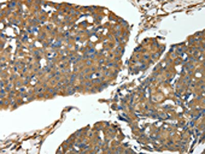 The image on the left is immunohistochemistry of paraffin-embedded Human breast cancer tissue using the antibody Antibody) at dilution 1/30, on the right is treated with fusion protein. (Original magnification: ×200)Rabbit anti-Human MSN Polyclonal Antibody