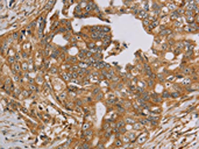 The image on the left is immunohistochemistry of paraffin-embedded Human cervical cancer tissue using NDUFA10 Antibody(NDUFA10 Antibody) at dilution 1/40, on the right is treated with fusion protein. (Original magnification: ×200)Rabbit anti-Human NDUFA10 Polyclonal Antibody