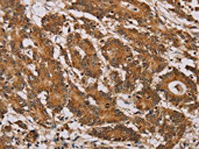 The image on the left is immunohistochemistry of paraffin-embedded Human colon cancer tissue using the antibody Antibody) at dilution 1/40, on the right is treated with fusion protein. (Original magnification: ×200)Rabbit anti-Human NDUFA10 Polyclonal Antibody