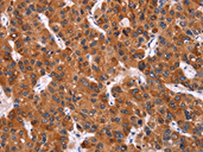 The image on the left is immunohistochemistry of paraffin-embedded Human liver cancer tissue using HMGCS2 Antibody(HMGCS2 Antibody) at dilution 1/40, on the right is treated with synthetic peptide. (Original magnification: ×200)Rabbit anti-Human HMGCS2 Polyclonal Antibody