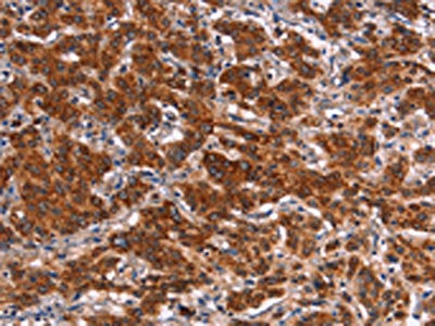 The image on the left is immunohistochemistry of paraffin-embedded Human gastic cancer tissue using the antibody Antibody) at dilution 1/40, on the right is treated with synthetic peptide. (Original magnification: ×200)Rabbit anti-Human HMGCS2 Polyclonal Antibody