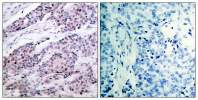 Immunohistochemical analysis of paraffin-embedded human breast carcinoma tissue using BCL-2(Ab-56) Antibody(left) or the same antibody preincubated with blocking peptide(right).