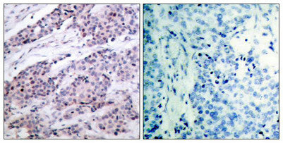 Immunohistochemical analysis of paraffin-embedded human breast carcinoma tissue using BCL-2(Ab-56) Antibody(left) or the same antibody preincubated with blocking peptide(right).