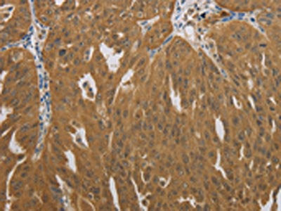 The image on the left is immunohistochemistry of paraffin-embedded Human ovarian cancer tissue using NIT2 Antibody(NIT2 Antibody) at dilution 1/40, on the right is treated with synthetic peptide. (Original magnification: ×200)Rabbit anti-Human NIT2 Polyclonal Antibody