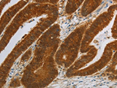 The image on the left is immunohistochemistry of paraffin-embedded Human colon cancer tissue using the antibody Antibody) at dilution 1/40, on the right is treated with synthetic peptide. (Original magnification: ×200)Rabbit anti-Human NIT2 Polyclonal Antibody