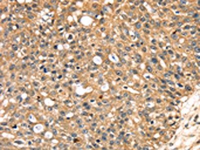 The image on the left is immunohistochemistry of paraffin-embedded Human breast cancer tissue using STX18 Antibody(STX18 Antibody) at dilution 1/20, on the right is treated with fusion protein. (Original magnification: ×200)Rabbit anti-Human STX18 Polyclonal Antibody