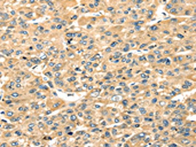 The image on the left is immunohistochemistry of paraffin-embedded Human liver cancer tissue using the antibody Antibody) at dilution 1/20, on the right is treated with fusion protein. (Original magnification: ×200)Rabbit anti-Human STX18 Polyclonal Antibody