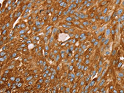 The image on the left is immunohistochemistry of paraffin-embedded Human breast cancer tissue using PAICS Antibody(PAICS Antibody) at dilution 1/35, on the right is treated with fusion protein. (Original magnification: ×200)Rabbit anti-Human PAICS Polyclonal Antibody