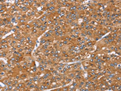 The image on the left is immunohistochemistry of paraffin-embedded Human liver cancer tissue using the antibody Antibody) at dilution 1/35, on the right is treated with fusion protein. (Original magnification: ×200)Rabbit anti-Human PAICS Polyclonal Antibody