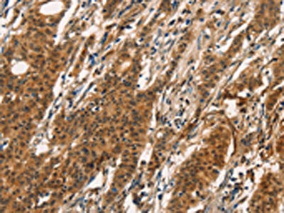 The image on the left is immunohistochemistry of paraffin-embedded Human gastric cancer tissue using CXCR6 Antibody(CXCR6 Antibody) at dilution 1/20, on the right is treated with fusion protein. (Original magnification: ×200)