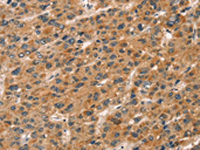 The image on the left is immunohistochemistry of paraffin-embedded Human liver cancer tissue using the antibody Antibody) at dilution 1/20, on the right is treated with fusion protein. (Original magnification: ×200)