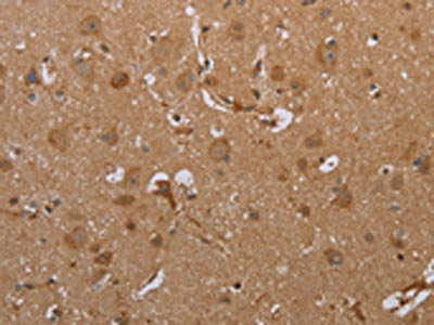 The image on the left is immunohistochemistry of paraffin-embedded Human brain  tissue using ATP2A1 Antibody(ATP2A1 Antibody) at dilution 1/35, on the right is treated with synthetic peptide. (Original magnification: ×200)Rabbit anti-Human ATP2A1 Polyclonal Antibody