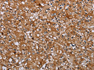 The image on the left is immunohistochemistry of paraffin-embedded Human prostate cancer tissue using the antibody Antibody) at dilution 1/35, on the right is treated with synthetic peptide. (Original magnification: ×200)