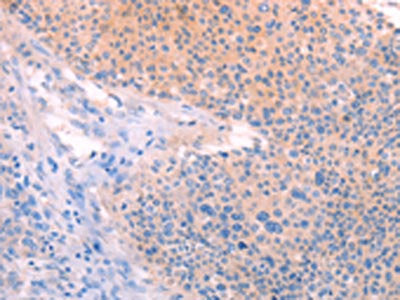 The image on the left is immunohistochemistry of paraffin-embedded Human liver cancer tissue using TIMP4 Antibody(TIMP4 Antibody) at dilution 1/15, on the right is treated with fusion protein. (Original magnification: ×200)Rabbit anti-Human TIMP4 Polyclonal Antibody