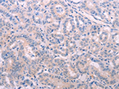 The image on the left is immunohistochemistry of paraffin-embedded Human thyroid cancer tissue using the antibody Antibody) at dilution 1/15, on the right is treated with fusion protein. (Original magnification: ×200)Rabbit anti-Human TIMP4 Polyclonal Antibody