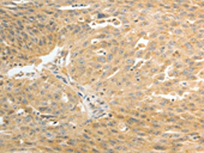 The image on the left is immunohistochemistry of paraffin-embedded Human ovarian cancer tissue using AKR1C1 Antibody(AKR1C1 Antibody) at dilution 1/30, on the right is treated with synthetic peptide. (Original magnification: ×200)Rabbit anti-Human AKR1C1 Polyclonal Antibody