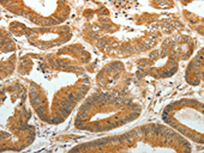 The image on the left is immunohistochemistry of paraffin-embedded Human colon cancer tissue using the antibody Antibody) at dilution 1/30, on the right is treated with synthetic peptide. (Original magnification: ×200)Rabbit anti-Human AKR1C1 Polyclonal Antibody