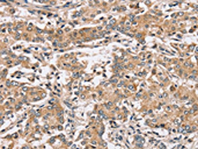 The image on the left is immunohistochemistry of paraffin-embedded Human liver cancer tissue using the antibody Antibody) at dilution 1/40, on the right is treated with synthetic peptide. (Original magnification: ×200)Rabbit anti-Human PPP1CC Polyclonal Antibody