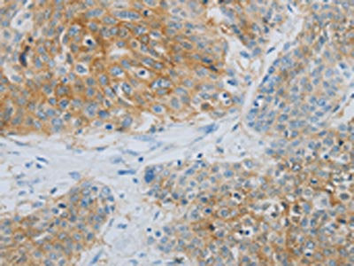 The image on the left is immunohistochemistry of paraffin-embedded Human esophagus cancer tissue using NDRG1 Antibody(NDRG1 Antibody) at dilution 1/70, on the right is treated with synthetic peptide. (Original magnification: ×200)Rabbit anti-Human NDRG1 Polyclonal Antibody