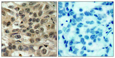 Immunohistochemical analysis of paraffin-embedded human breast carcinoma tissue using cdc25C(Ab-216) Antibody(left) or the same antibody preincubated with blocking peptide(right).Rabbit anti-Human CDC25C Polyclonal Antibody