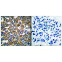 Immunohistochemical analysis of paraffin-embedded human breast carcinoma tissue using Keratin 15 antibody.