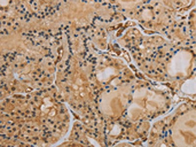 The image on the left is immunohistochemistry of paraffin-embedded Human thyroid cancer tissue using the antibody Antibody) at dilution 1/40, on the right is treated with synthetic peptide. (Original magnification: ×200)
