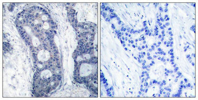 Immunohistochemical analysis of paraffin-embedded human breast carcinoma tissue using eIF4E(Ab-209) Antibody(left) or the same antibody preincubated with blocking peptide(right).Rabbit anti-Human EIF4E Polyclonal Antibody