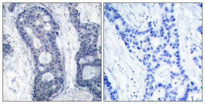 Immunohistochemical analysis of paraffin-embedded human breast carcinoma tissue using eIF4E(Ab-209) Antibody(left) or the same antibody preincubated with blocking peptide(right).Rabbit anti-Human EIF4E Polyclonal Antibody
