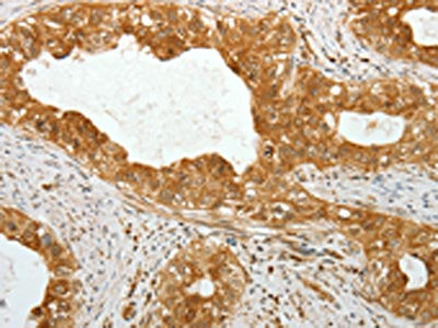 The image on the left is immunohistochemistry of paraffin-embedded Human cervical cancer tissue using TEKT1 Antibody(TEKT1 Antibody) at dilution 1/30, on the right is treated with fusion protein. (Original magnification: ×200)Rabbit anti-Human TEKT1 Polyclonal Antibody