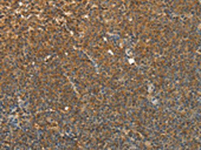 The image on the left is immunohistochemistry of paraffin-embedded Human lymphoma tissue using the antibody Antibody) at dilution 1/30, on the right is treated with fusion protein. (Original magnification: ×200)Rabbit anti-Human TEKT1 Polyclonal Antibody