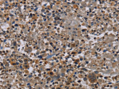 The image on the left is immunohistochemistry of paraffin-embedded Human lung cancer tissue using PVRL4 Antibody(PVRL4 Antibody) at dilution 1/60, on the right is treated with fusion protein. (Original magnification: ×200)Rabbit anti-Human PVRL4 Polyclonal Antibody