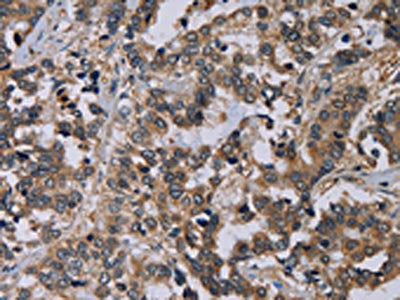 The image on the left is immunohistochemistry of paraffin-embedded Human liver cancer tissue using the antibody Antibody) at dilution 1/60, on the right is treated with fusion protein. (Original magnification: ×200)Rabbit anti-Human PVRL4 Polyclonal Antibody